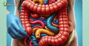 diverticulitis icd 10